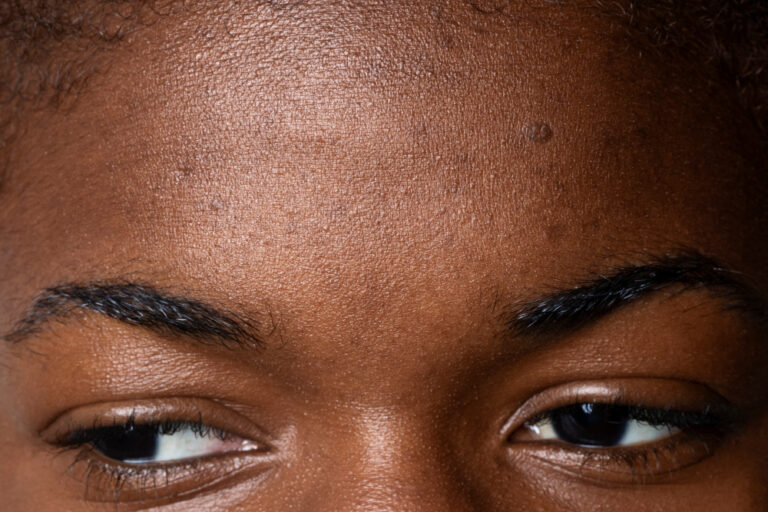How Do I Remove Acne and Pimples Permanently?